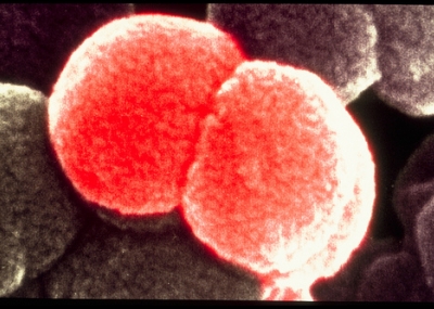ISP confirma que muestra recibida el miércoles era de meningitis W135 y que casos ya suman 44 en todo el país ISP confirma que muestra recibida el miércoles era de meningitis W135 y que casos ya suman 44 en todo el país