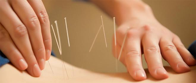 La acupuntura como alternativa para tratar las molestias alergias