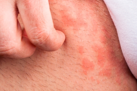 Urticaria crónica espontánea, una enfermedad difícil de diagnosticar Urticaria crónica espontánea, una enfermedad difícil de diagnosticar