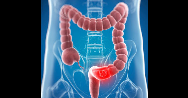 Cáncer colorrectal: la clave está en la prevención y el diagnóstico precoz Cáncer colorrectal: la clave está en la prevención y el diagnóstico precoz
