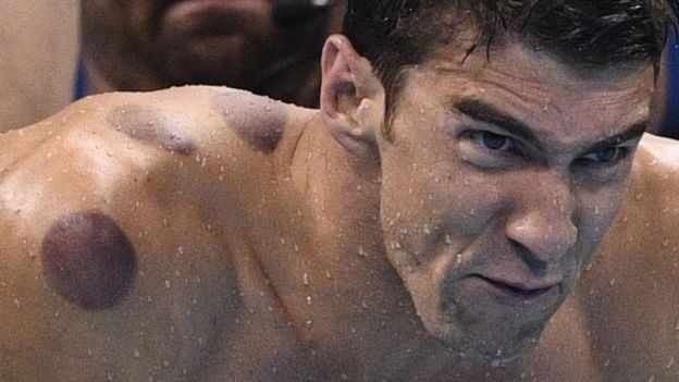 Río 2016: ¿qué son los círculos rojos en la espalda de Michael Phelps y otros atletas olímpicos? Río 2016: ¿qué son los círculos rojos en la espalda de Michael Phelps y otros atletas olímpicos?