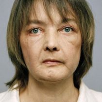 Muere la mujer francesa que recibió el primer trasplante parcial de cara