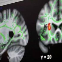 Neurocientíficos analizan con resonancia magnética cerebro de pedófilos