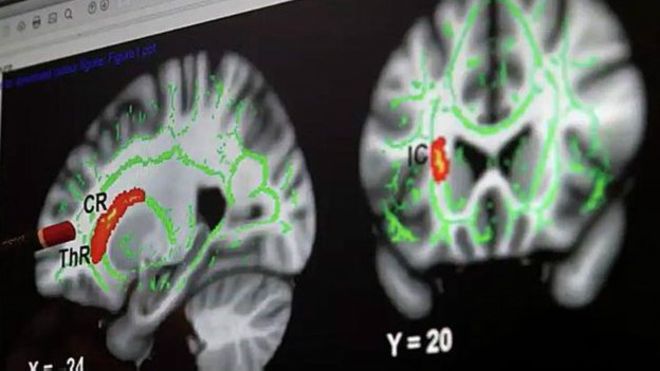 Neurocientíficos analizan con resonancia magnética cerebro de pedófilos Neurocientíficos analizan con resonancia magnética cerebro de pedófilos