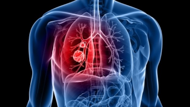 Cáncer de pulmón: principal causa de muerte en América Latina Cáncer de pulmón: principal causa de muerte en América Latina