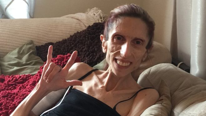 «No quiero ser la que no sobrevivió»: la nueva esperanza para Rachael, una mujer que pesa 20 kilos por causa de la anorexia «No quiero ser la que no sobrevivió»: la nueva esperanza para Rachael, una mujer que pesa 20 kilos por causa de la anorexia