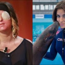 Modelo italiana desfigurada con ácido por su ex novio muestra su rostro en TV