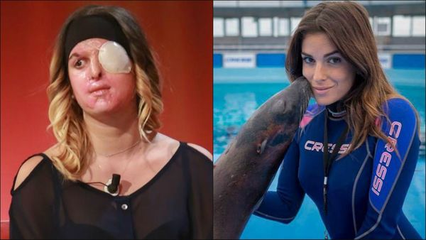 Modelo italiana desfigurada con ácido por su ex novio muestra su rostro en TV Modelo italiana desfigurada con ácido por su ex novio muestra su rostro en TV