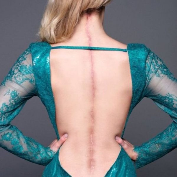 «Tengo una enfermedad invisible»: la reina de belleza con el Síndrome de Ehlers-Danlos