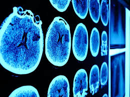 El prometedor avance contra la devastadora enfermedad neurodegenerativa de Huntington El prometedor avance contra la devastadora enfermedad neurodegenerativa de Huntington