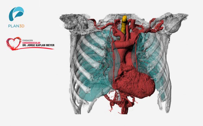 Cardiología Y Biomodelos 3D: Se unen para innovar en beneficio de los pacientes Cardiología Y Biomodelos 3D: Se unen para innovar en beneficio de los pacientes