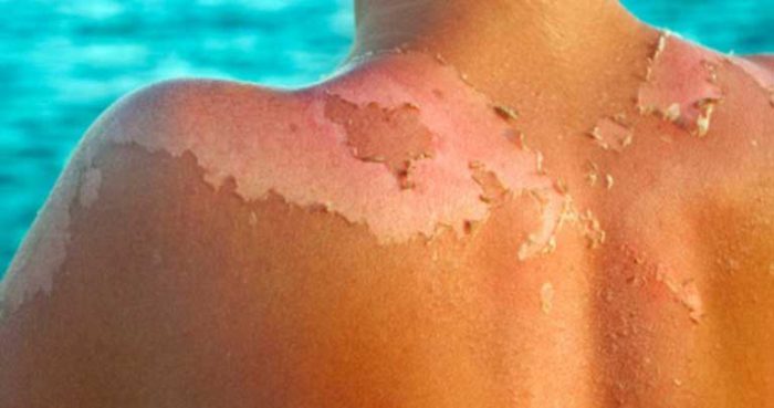 Previene las urgencias más frecuentes en verano Previene las urgencias más frecuentes en verano
