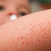 Científico busca determinar causas que  producen dermatitis atópica en chilenos