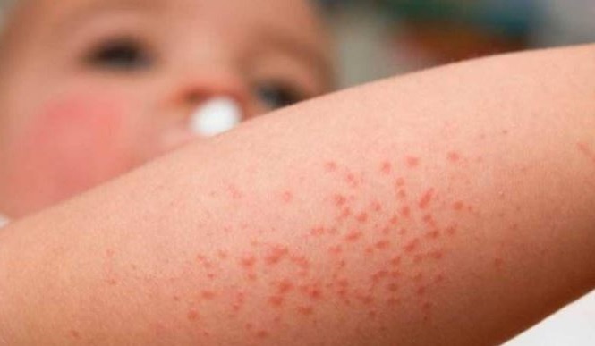 Científico busca determinar causas que  producen dermatitis atópica en chilenos