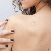 Revisa tus lunares y previene el cáncer de piel
