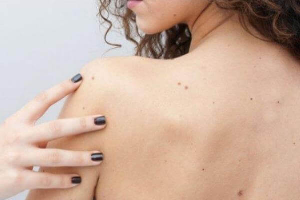 Revisa tus lunares y previene el cáncer de piel Revisa tus lunares y previene el cáncer de piel