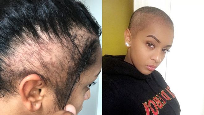 “Mi peinado terminó dejándome calva”: Paigey Cakey, la joven rapera británica con “alopecia de tracción” “Mi peinado terminó dejándome calva”: Paigey Cakey, la joven rapera británica con “alopecia de tracción”