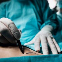 Cirugía bariátrica: aumenta demanda por operaciones en el último año pero advierten la importancia de un tratamiento multidisciplinario