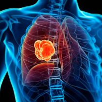 Estigma del cáncer de pulmón frena acceso a tratamientos en América Latina
