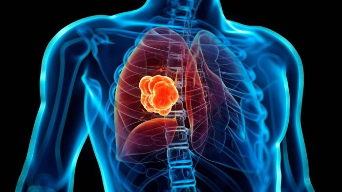 Estigma del cáncer de pulmón frena acceso a tratamientos en América Latina Estigma del cáncer de pulmón frena acceso a tratamientos en América Latina