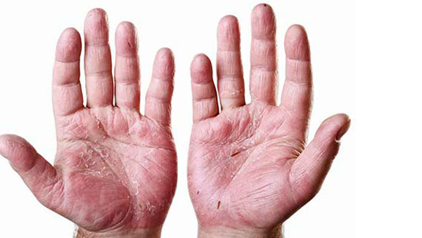 Artritis Psoriásica: una enfermedad que si no se controla puede llegar a ser invalidante Artritis Psoriásica: una enfermedad que si no se controla puede llegar a ser invalidante