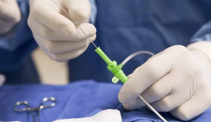¿Qué es la terapia endovascular y cómo te puede salvar la vida? ¿Qué es la terapia endovascular y cómo te puede salvar la vida?