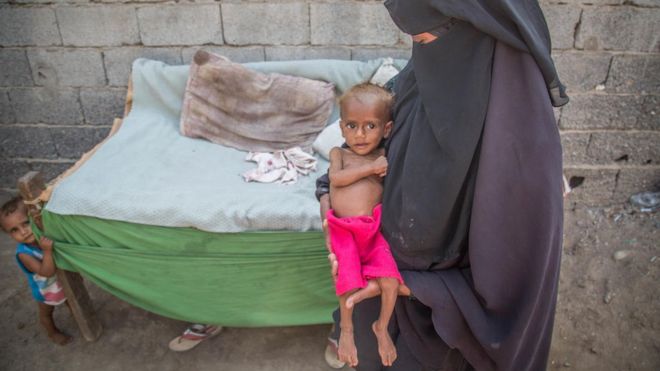Guerra en Yemen: 85.000 niños han muerto por desnutrición Guerra en Yemen: 85.000 niños han muerto por desnutrición