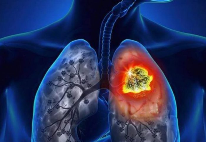 Cáncer de pulmón mata a más de tres mil chilenos al año, pese a disminución del consumo de tabaco Cáncer de pulmón mata a más de tres mil chilenos al año, pese a disminución del consumo de tabaco