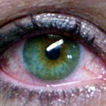 Síndrome de ojo seco puede derivar en necesidad de trasplante de córnea