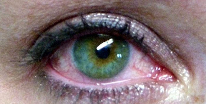 Síndrome de ojo seco puede derivar en necesidad de trasplante de córnea Síndrome de ojo seco puede derivar en necesidad de trasplante de córnea