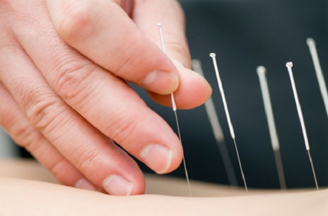 La acupuntura se abre paso como complemento para la salud bucal y dolor facial
