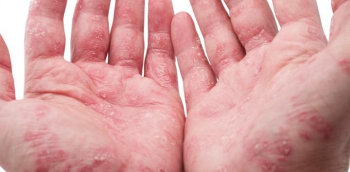 Corporación de Psoriásis de Chile en Alerta por Ley Ricarte Soto: “Una persona con artritis psoriática puede llegar a gastar 3 millones de pesos mensuales en su tratamiento” Corporación de Psoriásis de Chile en Alerta por Ley Ricarte Soto: “Una persona con artritis psoriática puede llegar a gastar 3 millones de pesos mensuales en su tratamiento”