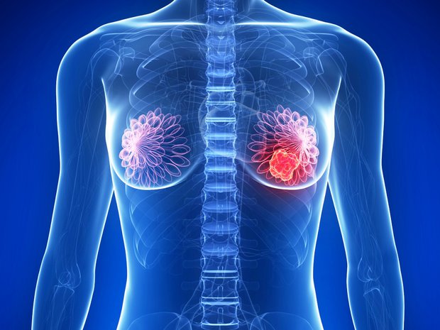 Estudio podría ayudar a detener metástasis en mujeres con cáncer de mama Estudio podría ayudar a detener metástasis en mujeres con cáncer de mama