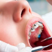 Frenillos después de los 30: adultos optan cada vez más por tratamientos de ortodoncia