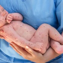 Sarampión: 8 mitos sobre las vacunas que pueden explicar los nuevos brotes de una enfermedad fácilmente evitable