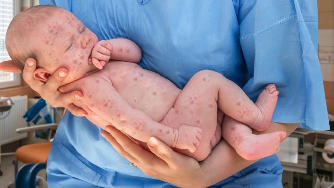 Sarampión: 8 mitos sobre las vacunas que pueden explicar los nuevos brotes de una enfermedad fácilmente evitable Sarampión: 8 mitos sobre las vacunas que pueden explicar los nuevos brotes de una enfermedad fácilmente evitable