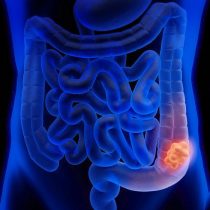 Especialistas en gastroenterología alertan sobre alza de cáncer de colon en Chile