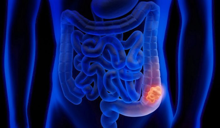 Especialistas en gastroenterología alertan sobre alza de cáncer de colon en Chile