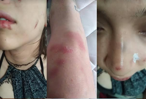 Pareja lésbica sufrió violento ataque en el Barrio Bellavista Pareja lésbica sufrió violento ataque en el Barrio Bellavista