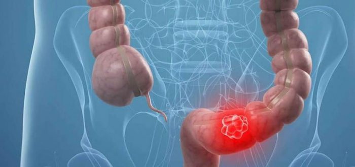 Cáncer colorrectal supera al digestivo en ranking chileno Cáncer colorrectal supera al digestivo en ranking chileno