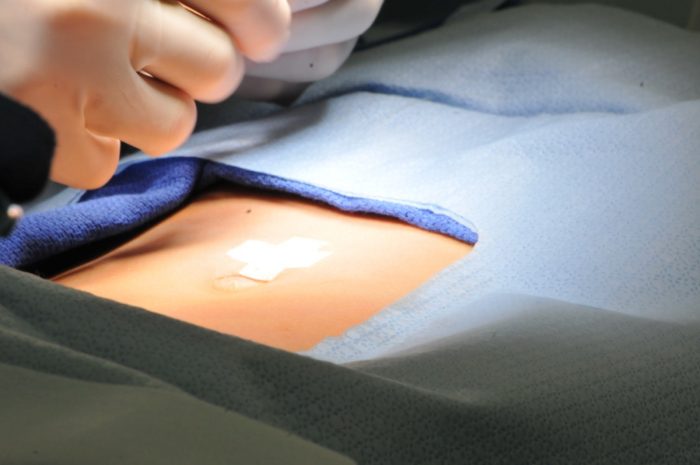 “Abdomen en delantal” y obesidad, un solo problema “Abdomen en delantal” y obesidad, un solo problema