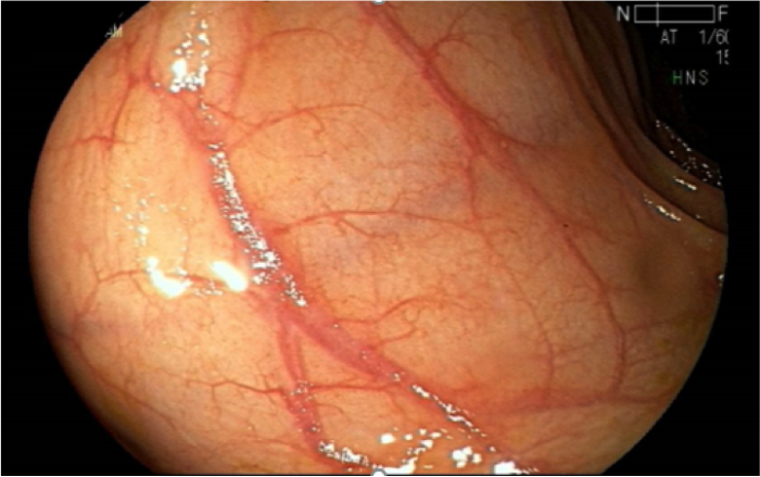 Ley Ricarte Soto acogerá casos graves de colitis ulcerosa Ley Ricarte Soto acogerá casos graves de colitis ulcerosa