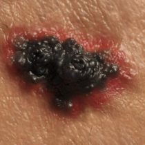 Cáncer de piel: el tratamiento que permite que el 52% de pacientes con melanoma avanzado sobreviva al menos 5 años