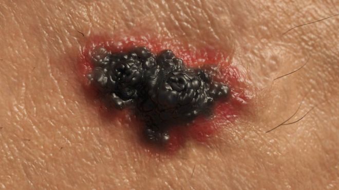 Cáncer de piel: el tratamiento que permite que el 52% de pacientes con melanoma avanzado sobreviva al menos 5 años