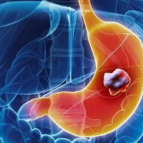 Estudio demuestra positivo uso de inmunoterapia en tratamiento de cáncer gástrico