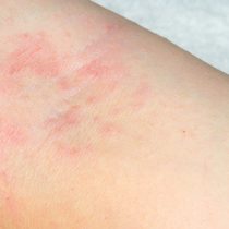 Las erupciones en la piel podrían ser otro síntoma clave del coronavirus