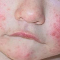 Dermatitis atópica, la enfermedad cutánea más frecuente en la niñez