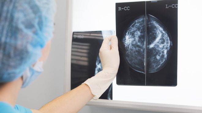 Cómo la inteligencia artificial “supera a médicos” en el diagnóstico de cáncer de mama Cómo la inteligencia artificial