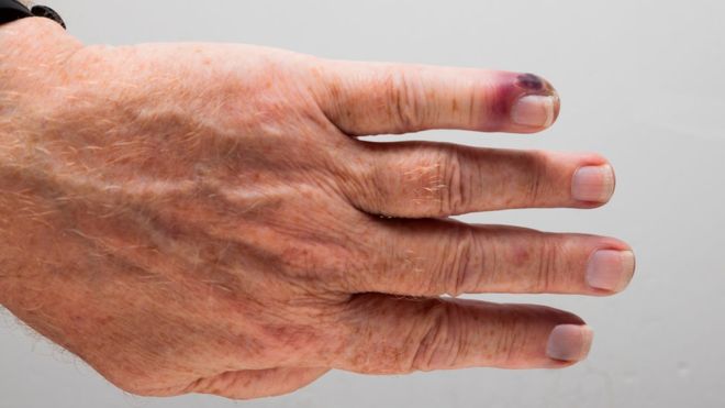 Septicemia, la enfermedad que mata anualmente a más personas que el cáncer en el mundo Septicemia, la enfermedad que mata anualmente a más personas que el cáncer en el mundo