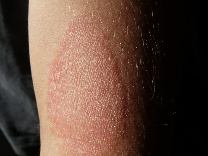 Pacientes de dermatitis atópica perciben un aumento de reacciones en la piel y picazón incontrolable en las noches Pacientes de dermatitis atópica perciben un aumento de reacciones en la piel y picazón incontrolable en las noches
